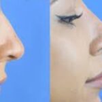 Informed Consent for Nose Filler Explained: A Practical Guide